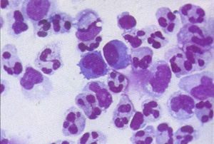 病毒性腦炎的病因