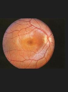 視神經萎縮 視神經萎縮