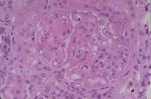 巰甲丙脯酸腎損害