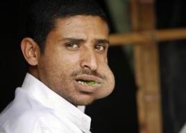 頜骨關節痛 頜骨關節痛