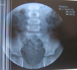 先天性脊柱裂 先天性脊柱裂