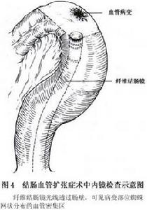 結腸血管擴張症