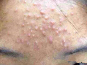 封閉性粉刺 封閉性粉刺