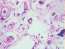 胃低分化腺癌 胃低分化腺癌