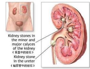 腎結石