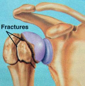 慢性關節炎 慢性關節炎