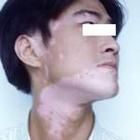 男性白癜風 男性白癜風