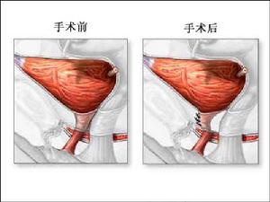 （圖）陰道前壁修補手術可以緩解大約60%婦女的症狀