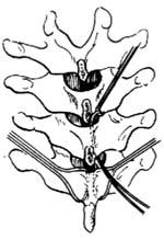 示意圖2:椎板下穿過鋼絲
