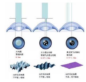 準分子雷射近視手術 準分子雷射近視手術
