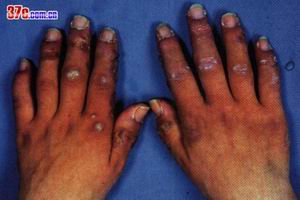 非特異性系統性壞死性小血管炎