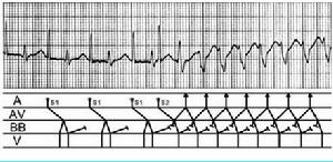圖4束支阻滯伴隱匿性傳導
