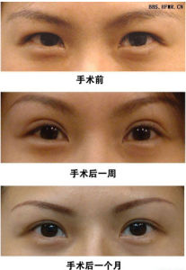 微創雙眼皮 微創雙眼皮