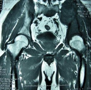 骨盆癌影像學表現