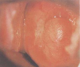 宮頸充血 宮頸充血