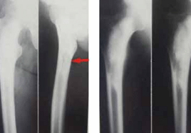 急性血源性骨髓炎
