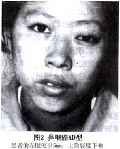 鼻咽癌的眼部病變