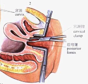 盆腔膿腫