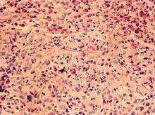 鼻腦毛霉病 鼻腦毛霉病