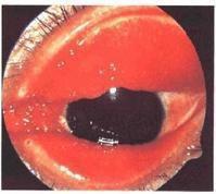 急性流行性結膜炎 急性流行性結膜炎