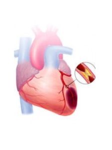 急性心肌梗死 急性心肌梗死