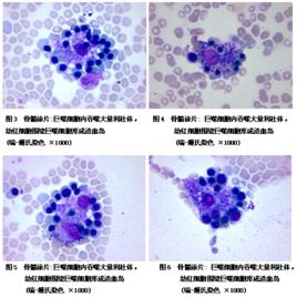 痰液分泌型IgE 痰液分泌型IgE