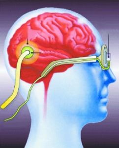 感覺補償 感覺補償