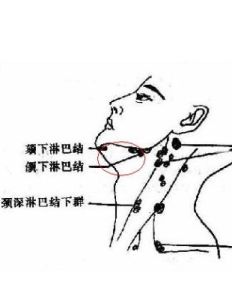 淋巴結腫大 淋巴結腫大