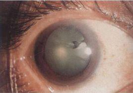 晶狀體內異物取出術 晶狀體內異物取出術