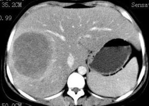 糖原累積症 糖原累積症
