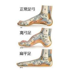 先天性高弓足 先天性高弓足