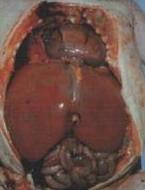 尼曼匹克氏病肝脾腫大