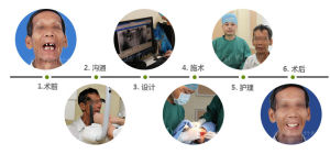 中山醫即刻用種植牙