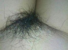 陰毛早發育 陰毛早發育