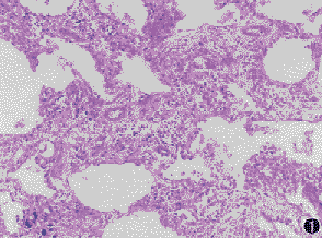 非特異性間質性肺炎