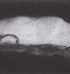 白色梗死 白色梗死