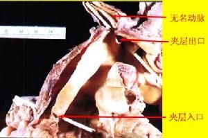 二尖瓣脫垂綜合症 二尖瓣脫垂綜合症