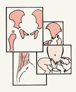 先天性髖關節發育不良 先天性髖關節發育不良