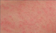 常見的切削液產品對皮膚的刺激和破壞