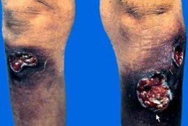 淋病梅毒 淋病梅毒