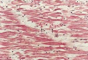 老年人急性心肌梗死