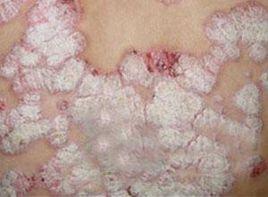 嬰兒頭皮結血痂 嬰兒頭皮結血痂