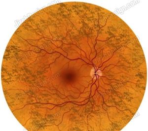 （圖）糖尿病視網膜