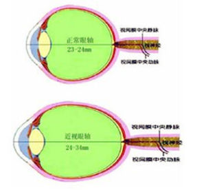 近視眼手術後遺症 近視眼手術後遺症