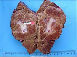 肝局灶性結節樣增生