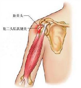 （圖）膕肌肌腱炎