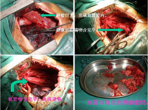 腔靜脈阻塞綜合徵 腔靜脈阻塞綜合徵
