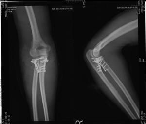 肘關節恐怖三聯征 肘關節恐怖三聯征