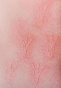 人工劃痕症 人工劃痕症