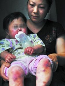 自身免疫性血小板減少性紫癜